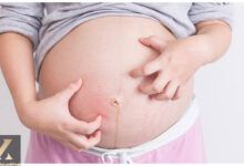 خارش در دوران بارداری