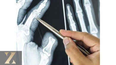 شکستگی استخوان در دست و انگشتان