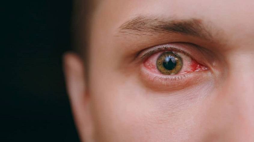 التهاب چشم در بزرگسالان
